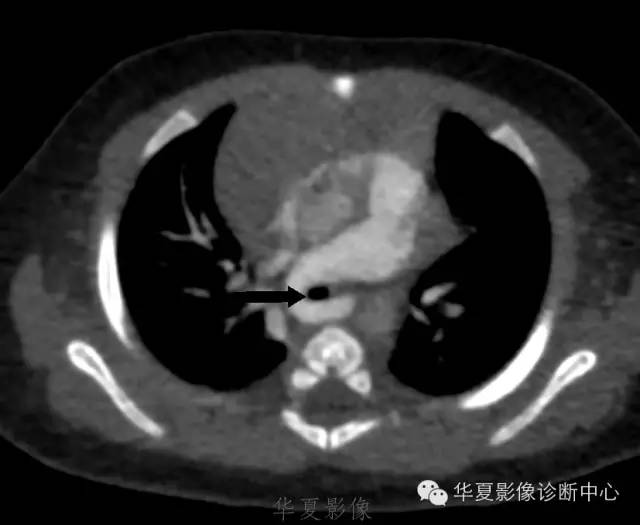 【病例】肺动脉吊带1例CT影像表现 【病例】肺动脉吊带1例CT影像表现