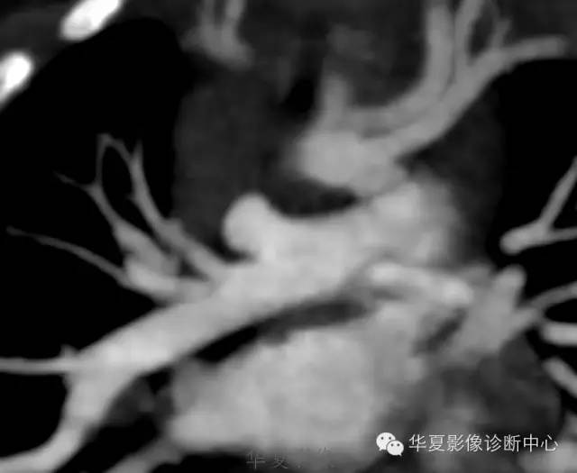 【病例】肺动脉吊带1例CT影像表现 【病例】肺动脉吊带1例CT影像表现