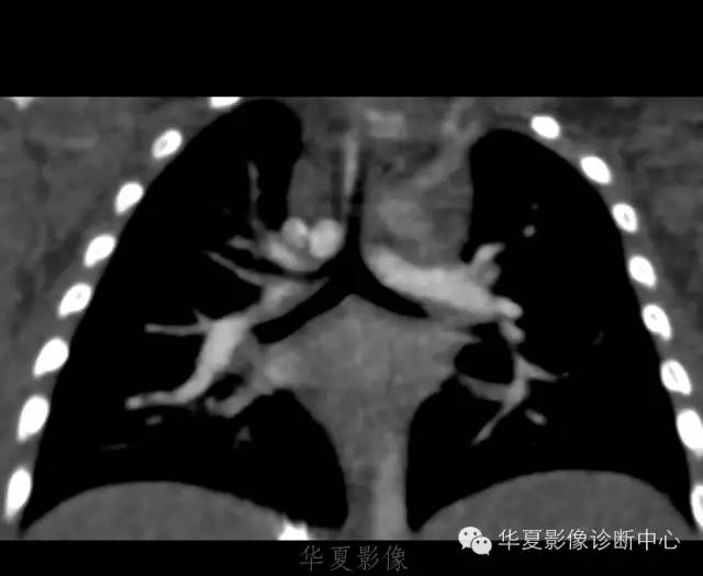 【病例】肺动脉吊带1例CT影像表现 【病例】肺动脉吊带1例CT影像表现
