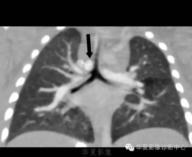 【病例】肺动脉吊带1例CT影像表现 【病例】肺动脉吊带1例CT影像表现
