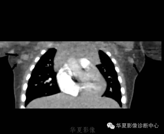 【病例】肺动脉吊带1例CT影像表现 【病例】肺动脉吊带1例CT影像表现