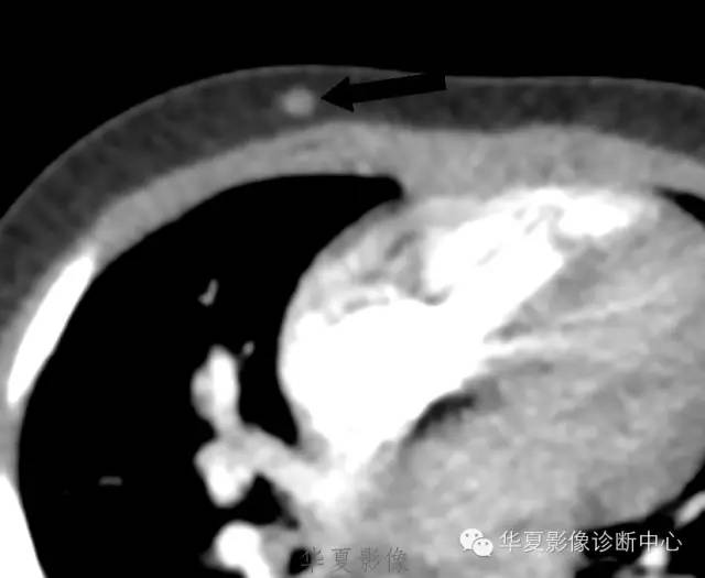 【病例】肺动脉吊带1例CT影像表现 【病例】肺动脉吊带1例CT影像表现