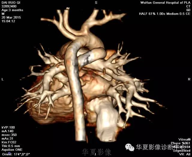 【病例】肺动脉吊带1例CT影像表现 【病例】肺动脉吊带1例CT影像表现