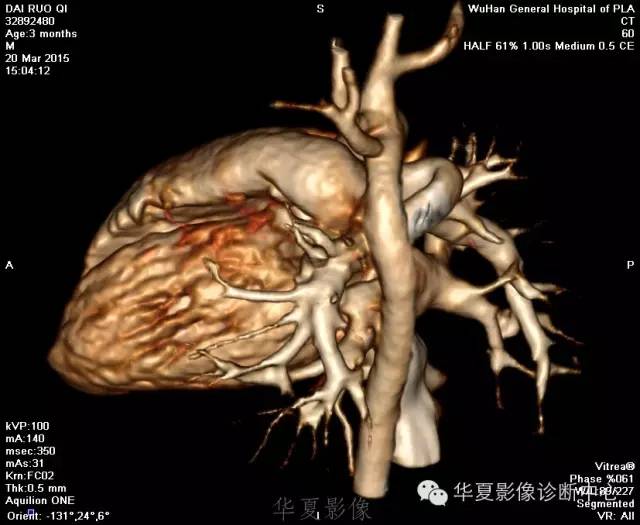 【病例】肺动脉吊带1例CT影像表现 【病例】肺动脉吊带1例CT影像表现