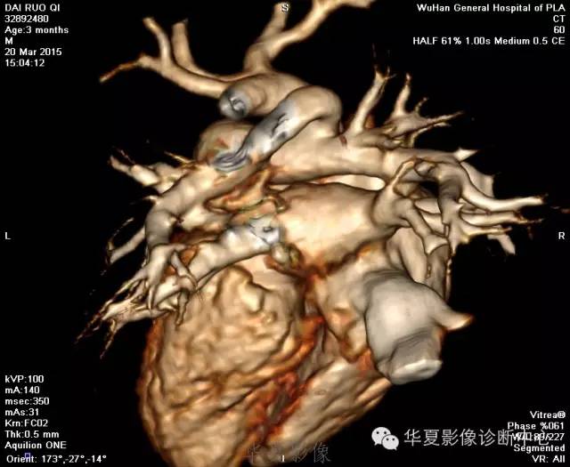 【病例】肺动脉吊带1例CT影像表现 【病例】肺动脉吊带1例CT影像表现