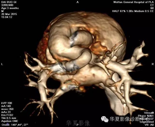 【病例】肺动脉吊带1例CT影像表现 【病例】肺动脉吊带1例CT影像表现