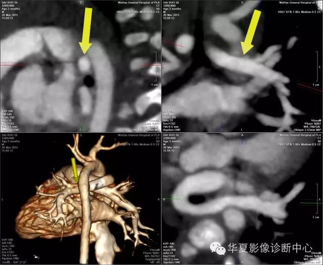 【病例】肺动脉吊带1例CT影像表现 【病例】肺动脉吊带1例CT影像表现