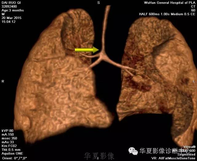 【病例】肺动脉吊带1例CT影像表现 【病例】肺动脉吊带1例CT影像表现