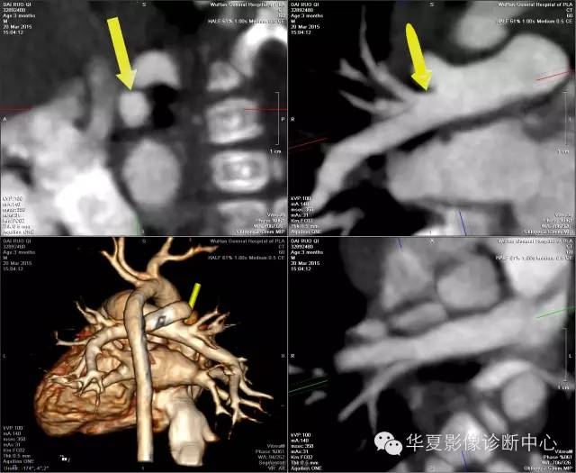 【病例】肺动脉吊带1例CT影像表现 【病例】肺动脉吊带1例CT影像表现