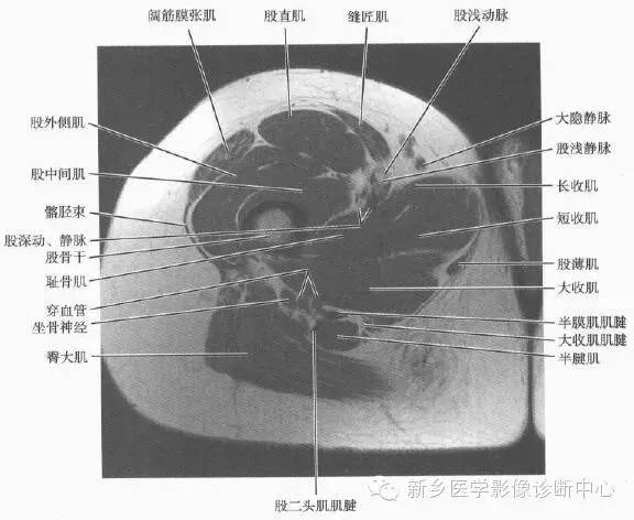 大腿解剖+详细标注