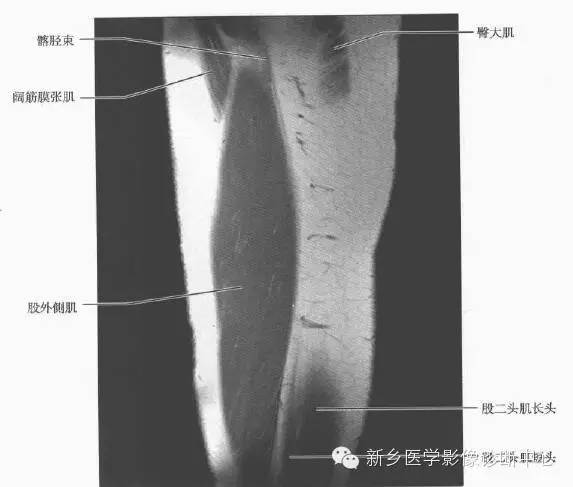 大腿解剖+详细标注