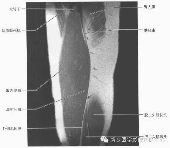大腿解剖+详细标注