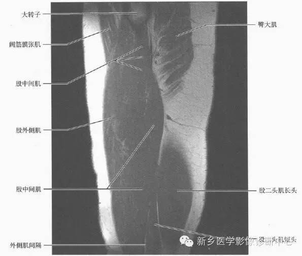 大腿解剖+详细标注