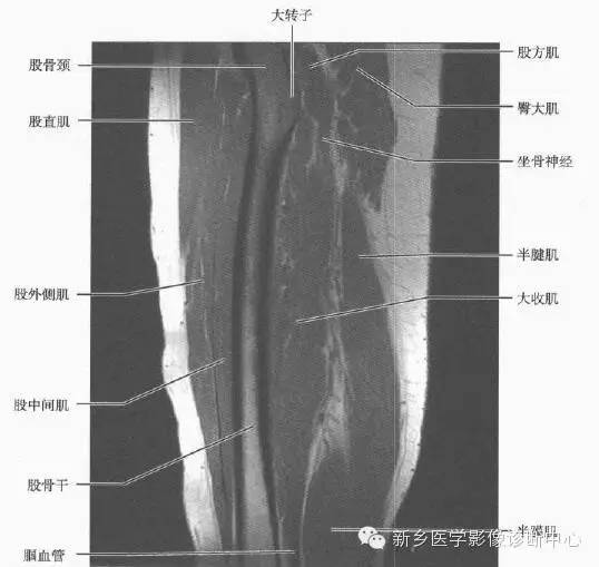 大腿解剖+详细标注