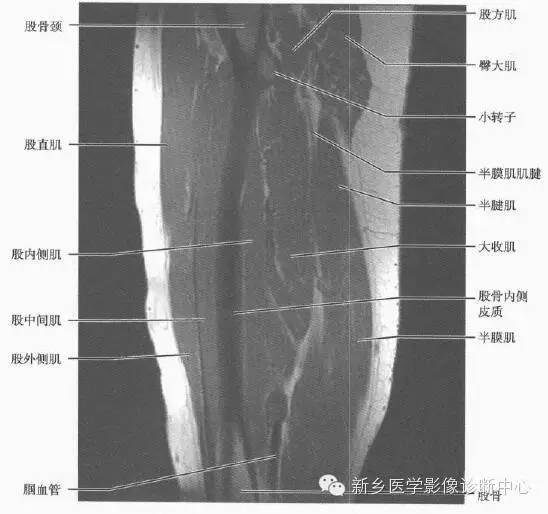 大腿解剖+详细标注