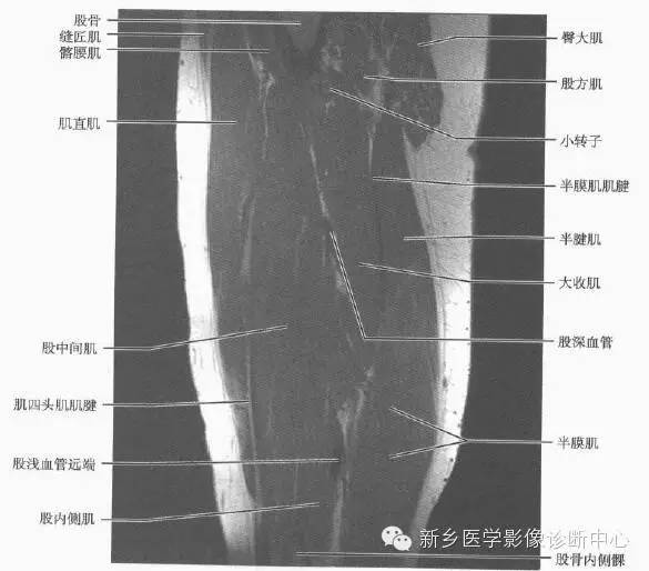 大腿解剖+详细标注