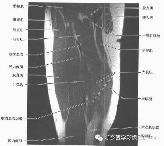 大腿解剖+详细标注