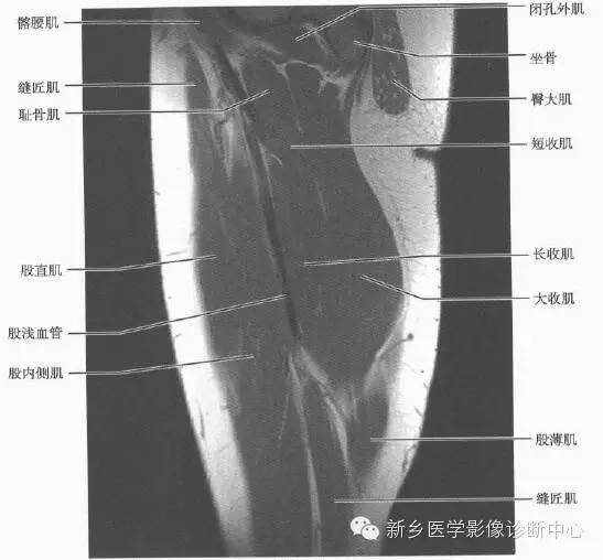 大腿解剖+详细标注