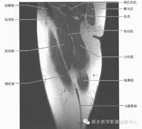 大腿解剖+详细标注