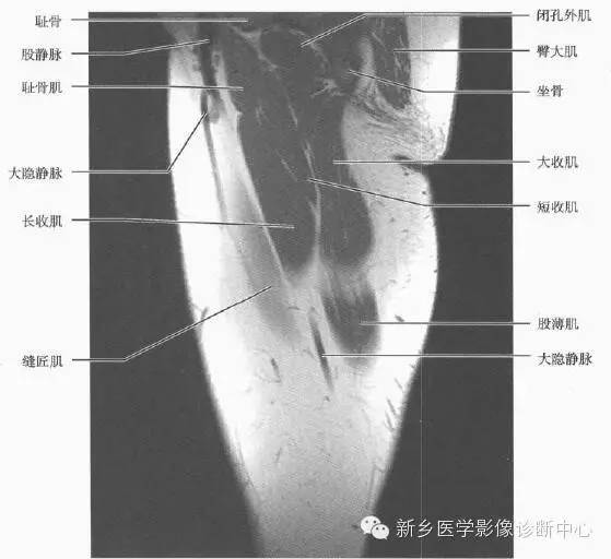 大腿解剖+详细标注