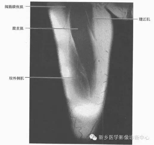 大腿解剖+详细标注