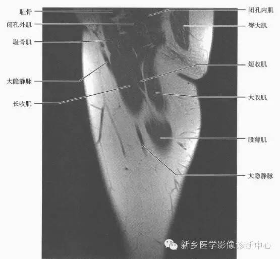 大腿解剖+详细标注