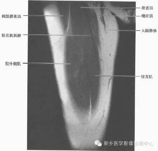 大腿解剖+详细标注