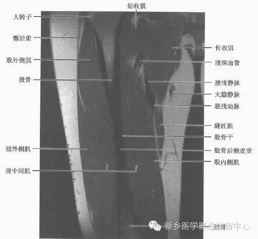 大腿解剖+详细标注