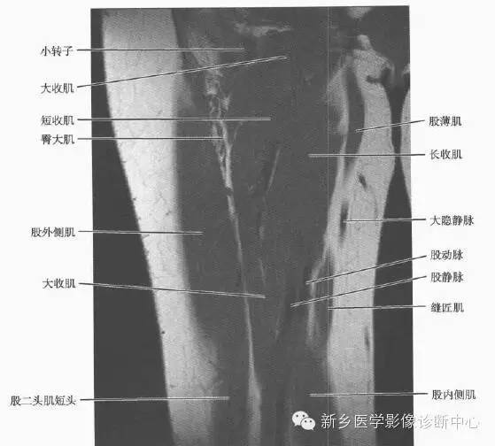 大腿解剖+详细标注