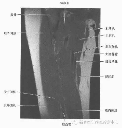 大腿解剖+详细标注