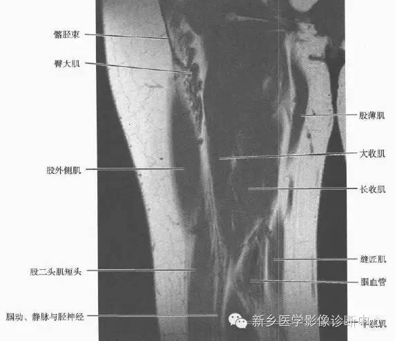 大腿解剖+详细标注