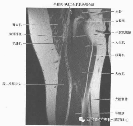 大腿解剖+详细标注