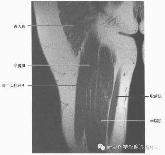 大腿解剖+详细标注