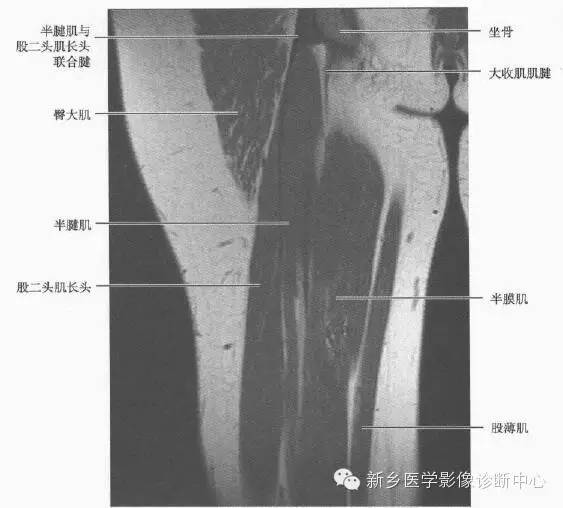 大腿解剖+详细标注