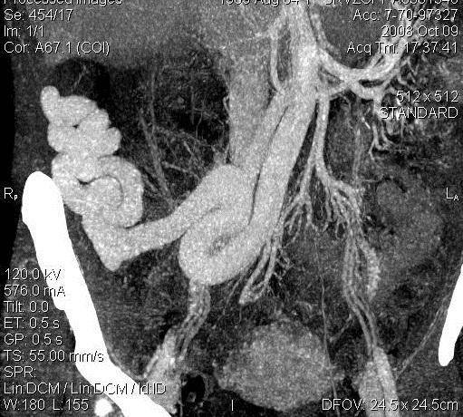 【病例】先天性肝纤维化1例CT及MR影像表现 【病例】先天性肝纤维化1例CT及MR影像表现