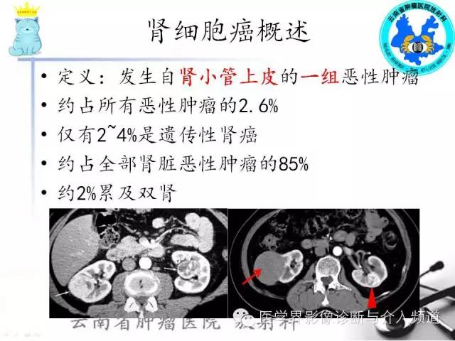 【PPT】肾细胞癌CT诊断及鉴别诊断