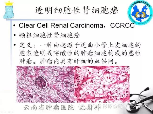 【PPT】肾细胞癌CT诊断及鉴别诊断