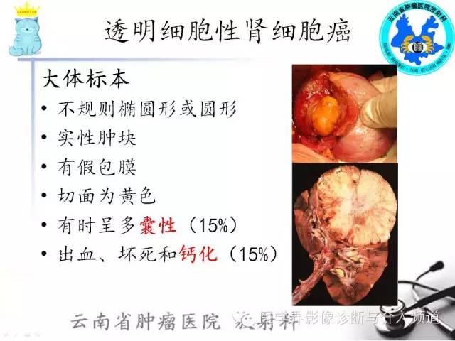 【PPT】肾细胞癌CT诊断及鉴别诊断