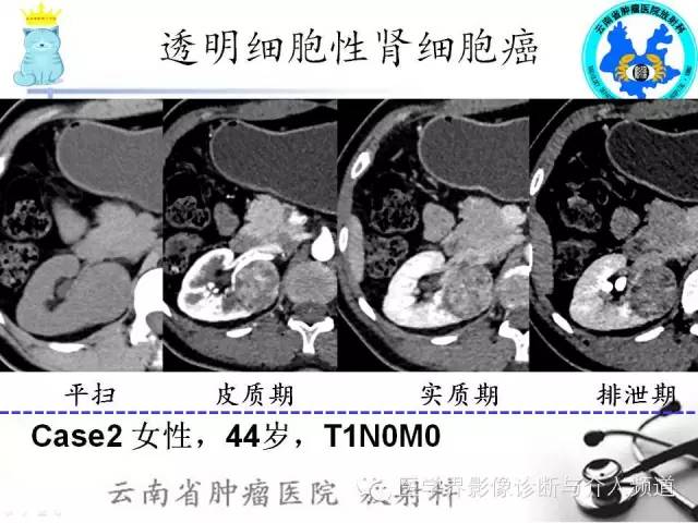 【PPT】肾细胞癌CT诊断及鉴别诊断