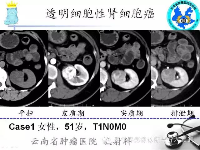 【PPT】肾细胞癌CT诊断及鉴别诊断