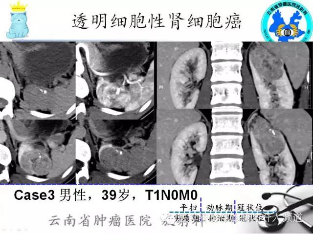 【PPT】肾细胞癌CT诊断及鉴别诊断
