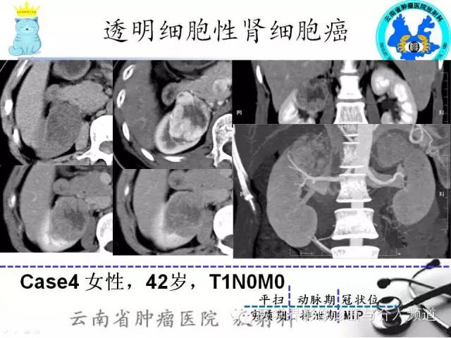 【PPT】肾细胞癌CT诊断及鉴别诊断