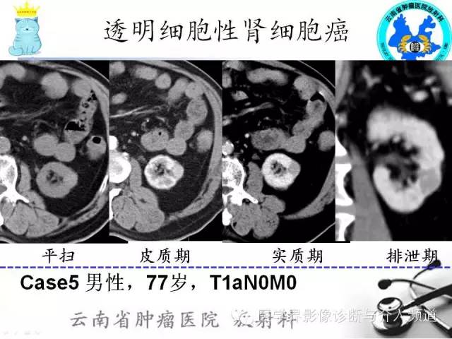 【PPT】肾细胞癌CT诊断及鉴别诊断