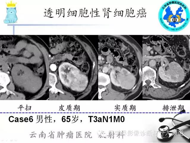 【PPT】肾细胞癌CT诊断及鉴别诊断