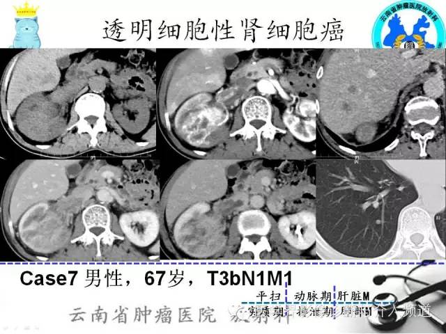 【PPT】肾细胞癌CT诊断及鉴别诊断