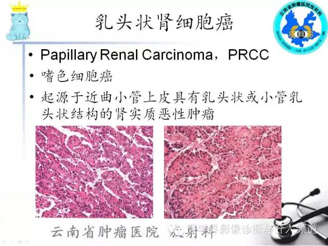 【PPT】肾细胞癌CT诊断及鉴别诊断