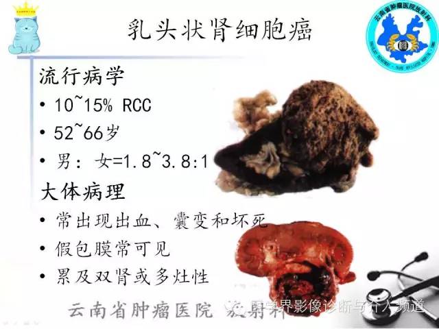 【PPT】肾细胞癌CT诊断及鉴别诊断
