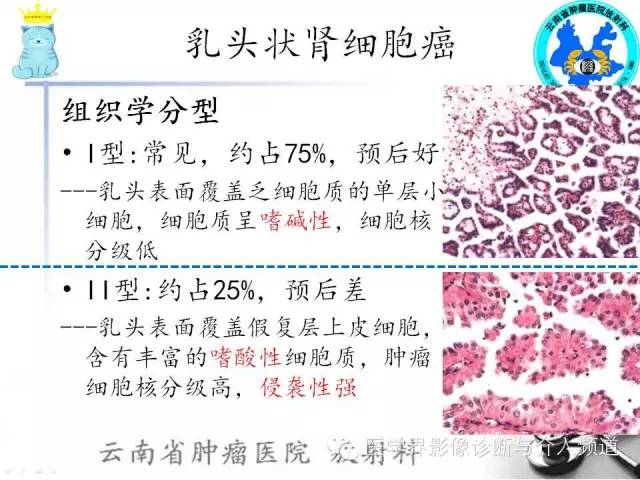 【PPT】肾细胞癌CT诊断及鉴别诊断