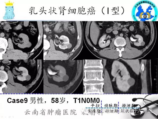 【PPT】肾细胞癌CT诊断及鉴别诊断