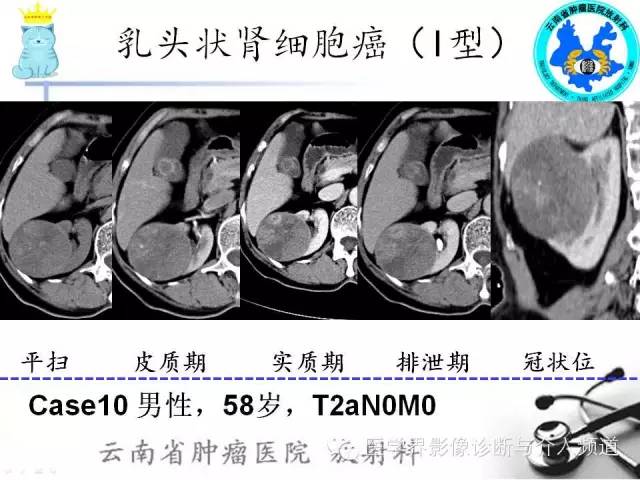 【PPT】肾细胞癌CT诊断及鉴别诊断